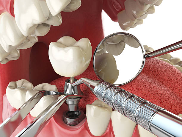 Best Emergency Dental Care for Abscessed Tooth in Chester Gap, VA